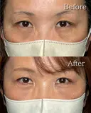 表ハムラ/眼輪筋吊り上げ before画像 サムネイル用