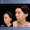 ✨オーダーメイドで叶える理想の鼻✨ 0日後 サムネイル用