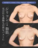 シリコンバッグ除去+リポクリ式PAL脂肪豊胸 120日後 サムネイル用