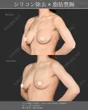 シリコンバッグ除去+リポクリ式PAL脂肪豊胸 before画像 サムネイル用