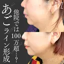 【ミニ脂肪吸引】他院では100万超…？ after画像 サムネイル用