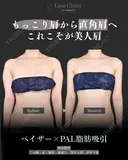 二の腕+肩、副乳脂肪吸引 90日後 サムネイル用