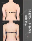 二の腕+肩、副乳脂肪吸引 before画像 サムネイル用