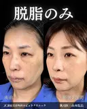 山本の🎀クマ取り🎀 before画像 サムネイル用