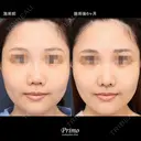 MU 鼻中隔延長術修正術（肋軟骨）＋他院鼻プロテーゼ入れ替え術＋眉間プロテーゼ（特別注文プロテーゼ） before画像 サムネイル用