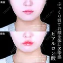 唇ヒアルロン酸 before画像 サムネイル用
