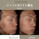 【井畑Dr】イソトレチノイン療法 before画像 サムネイル用