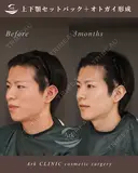 上下セットバック＋オトガイ形成 after画像 サムネイル用