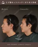 上下セットバック＋オトガイ形成 after画像 サムネイル用