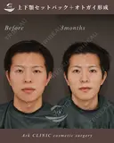 上下セットバック＋オトガイ形成 after画像 サムネイル用