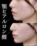 顎ヒアルロン酸 after画像 サムネイル用
