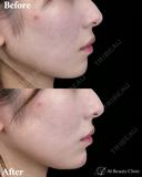 顎ヒアルロン酸 before画像 サムネイル用