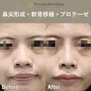 【安形Dr】耳介軟骨移植（鼻）・鼻尖形成術鼻・プロテーゼ(隆鼻術) after画像 サムネイル用