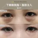 【安形Dr】下眼瞼脱脂＋脂肪注入（目の下） before画像 サムネイル用