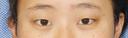ナチュラル二重埋没法 before画像 サムネイル用