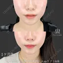 【ミニ脂肪吸引】プレ花嫁ダウンタイム間に合う？ before画像 サムネイル用