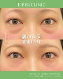 "化粧で隠せない 凹凸に裏ハムラ" before画像 サムネイル用