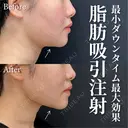 脂肪吸引注射 after画像 サムネイル用