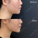 脂肪吸引注射 after画像 サムネイル用
