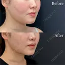 脂肪吸引注射 after画像 サムネイル用