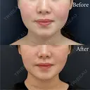 脂肪吸引注射 after画像 サムネイル用