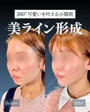 岩﨑先生による🔥小顔整形🔥 after画像 サムネイル用