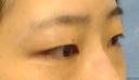 ナチュラル埋没法 before画像 サムネイル用