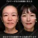 プロテーゼを自家組織に変える 90日後 サムネイル用