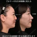 プロテーゼを自家組織に変える 90日後 サムネイル用
