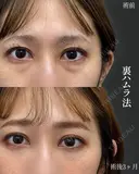目元の症例集（クマ治療・目元拡大術） before画像 サムネイル用