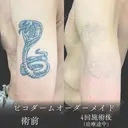 【タトゥー除去】左腕のコブラ before画像 サムネイル用