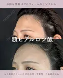 額ヒアルロン酸 after画像 サムネイル用