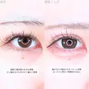 アリエルクイックループダブル二重埋没法/瞼の上の脂肪取り/涙袋ヒアルロン酸 before画像 サムネイル用