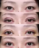【20代女性・二重切開で綺麗な平行二重に】二重切開（1ヶ月後） 30日後 サムネイル用