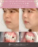 出っ歯🐰口元の膨らみ🎈上下セットバック 90日後 サムネイル用