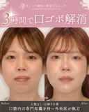 出っ歯🐰口元の膨らみ🎈上下セットバック 90日後 サムネイル用