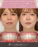 出っ歯🐰口元の膨らみ🎈上下セットバック 90日後 サムネイル用