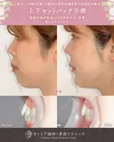 出っ歯🐰口元の膨らみ🎈上下セットバック 90日後 サムネイル用