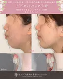出っ歯🐰口元の膨らみ🎈上下セットバック 180日後 サムネイル用