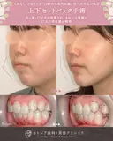 出っ歯🐰口元の膨らみ🎈上下セットバック 180日後 サムネイル用