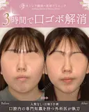 出っ歯🐰口元の膨らみ🎈上下セットバック 180日後 サムネイル用