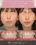 出っ歯🐰口元の膨らみ🎈上下セットバック 180日後 サムネイル用