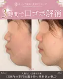 出っ歯🐰口元の膨らみ🎈上下セットバック before画像 サムネイル用