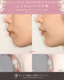 出っ歯🐰口元の膨らみ🎈上下セットバック 180日後 サムネイル用