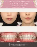 出っ歯🐰口元の膨らみ🎈上下セットバック 180日後 サムネイル用