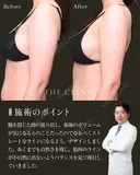 理想のストレート二の腕に｜二の腕の360°脂肪吸引 after画像 サムネイル用