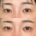 涙袋ヒアルロン酸 before画像 サムネイル用
