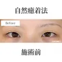 自然癒着法 before画像 サムネイル用