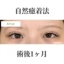 自然癒着法 after画像 サムネイル用