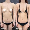 二の腕脂肪吸引＋脂肪豊胸 before画像 サムネイル用